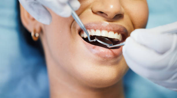 Best Emergency Dental Extractions in Bellview, FL